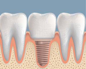 dental implants