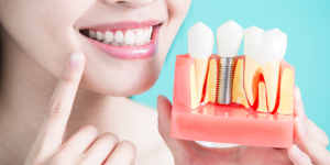 woman holding a model of a dental implant